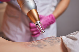 Tattoo and Permanent Makeup Laser Removal Online Makeup Classes